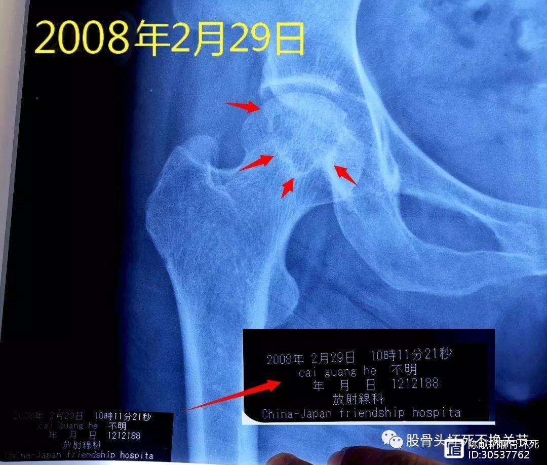 保山人工骨头医保报销多少(人工骨头医保报销多少比例)